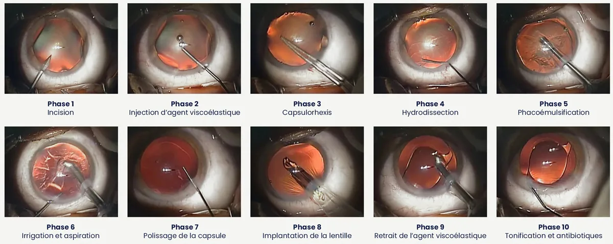Chirurgie cataracte Sousse Tunisie