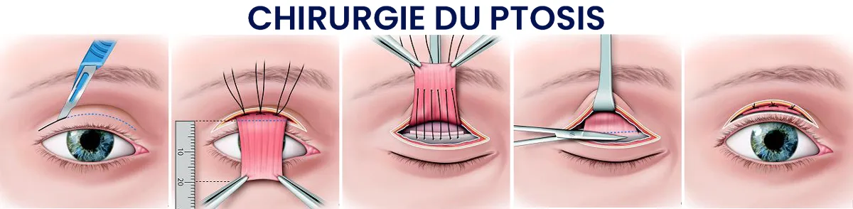 Chirurgie du ptosis Sousse Tunisie