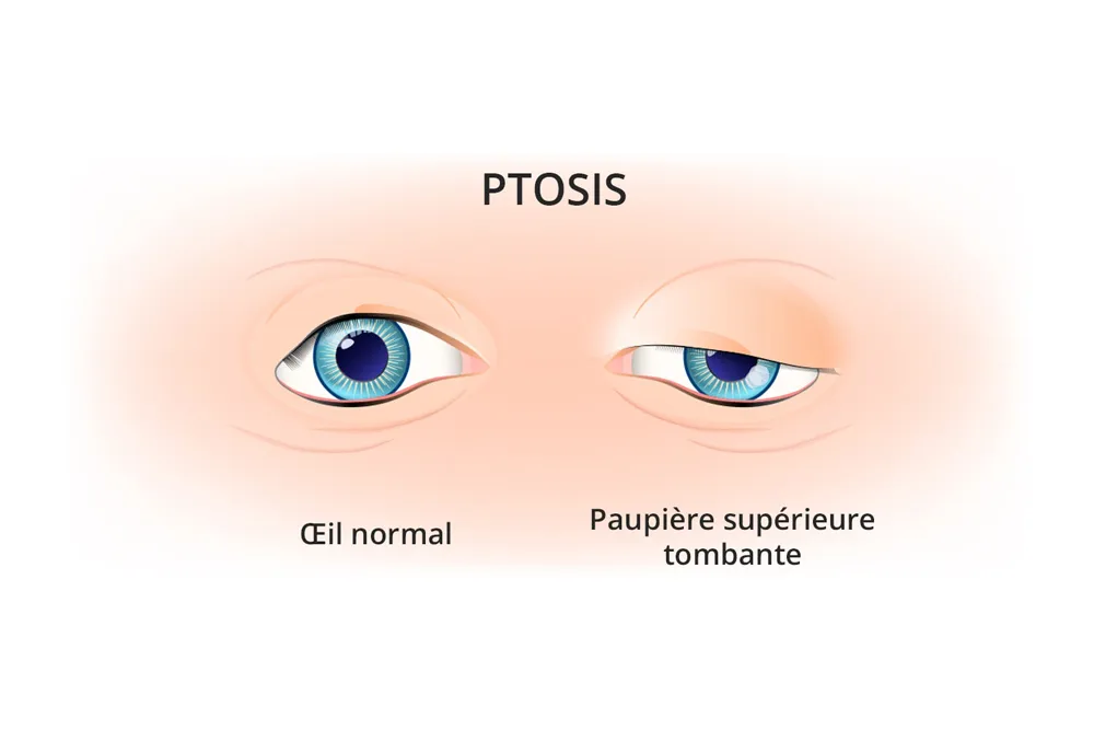 Chirurgie du ptosis Sousse Tunisie
