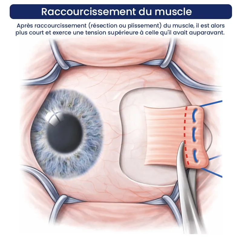 Chirurgie Strabisme Sousse Tunisie