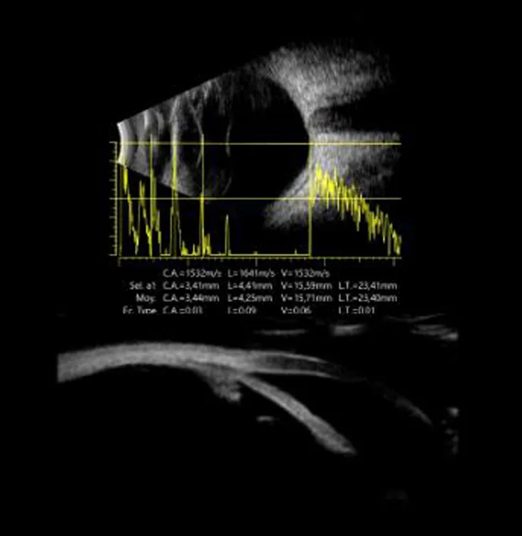 Echographie oculaire Sousse Tunisie