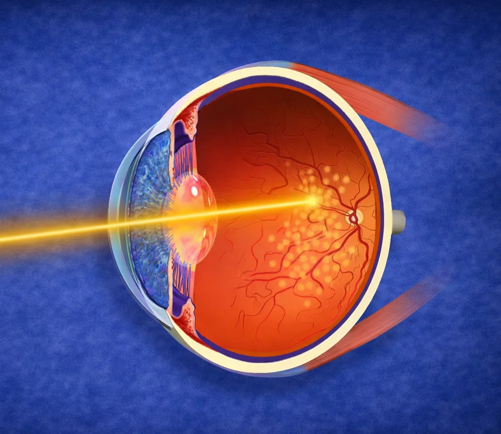 Laser PPR photocoagulation Sousse Tunisie