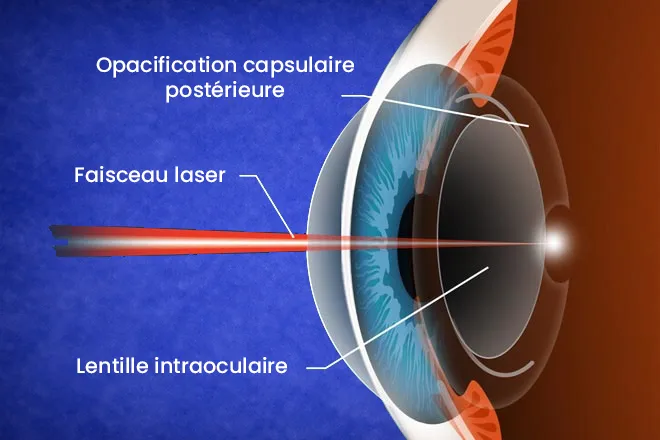 Laser YAG capsulotomie Sousse Tunisie