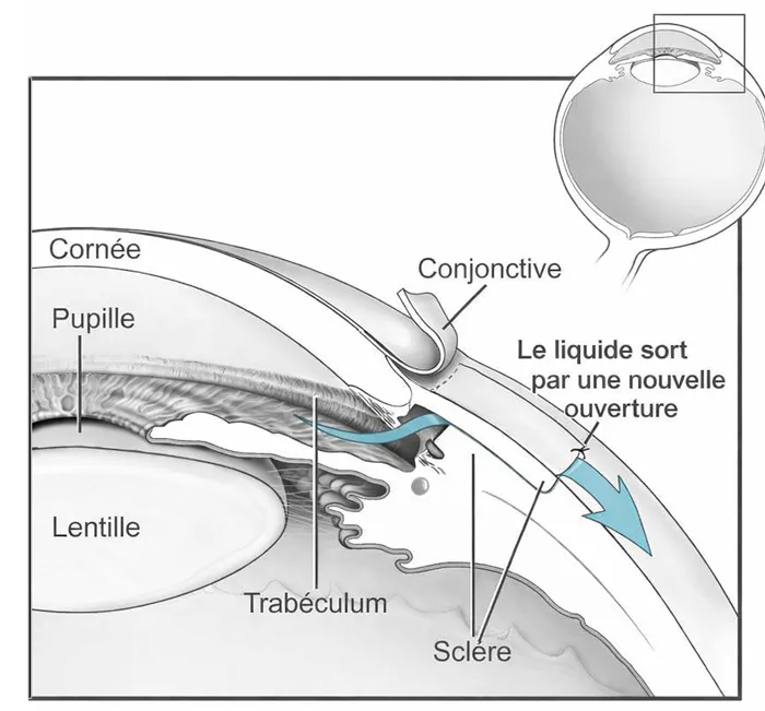 Chirurgie glaucome trabéculectomie Sousse Tunisie